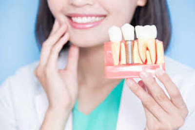 Dental implants in Islamabad: 