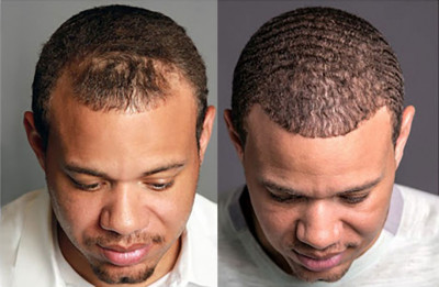 Hair transplant in Islamabad: 