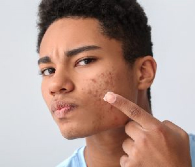 Acne Scar Treatment in Islamabad