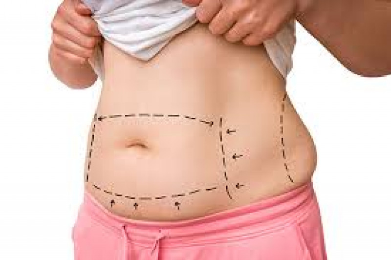 Tummy tuck in in pakistan: 