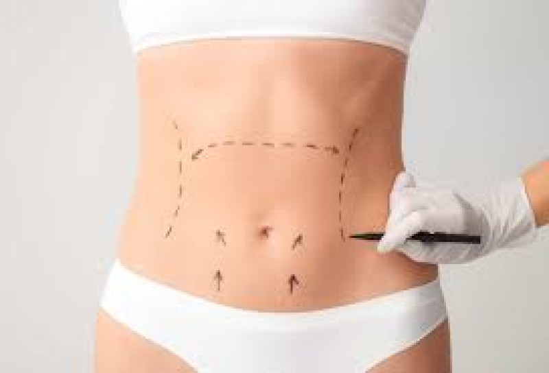 Abdominoplasty in Islamabad, Pakistan: 