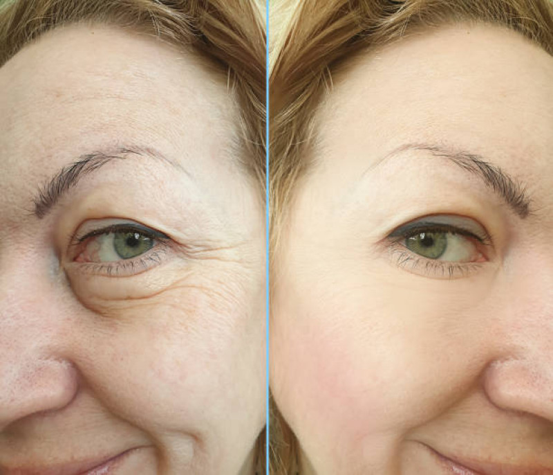 Botox For Wrinkles In Islamabad: 
