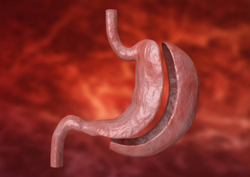 Bariatric Surgery In Islamabad, Rawalpindi, And Pakistan: 