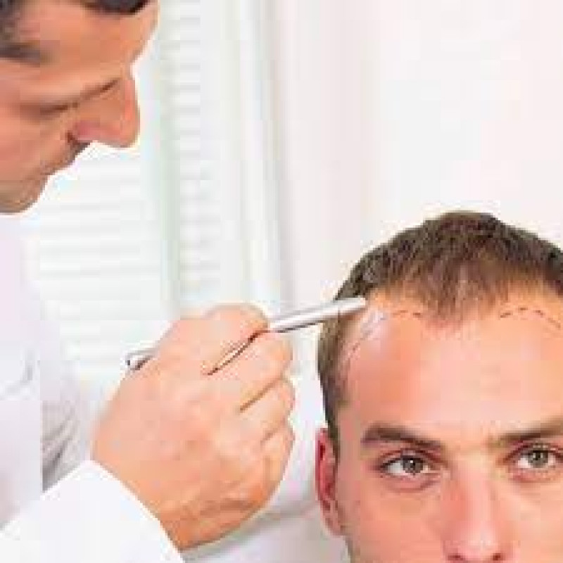 Hair Transplant in Islamabad